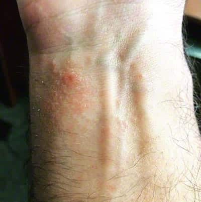 Poison ivy rash on the wrist.