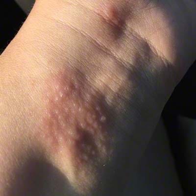 Poison ivy rash on the center of wrist.