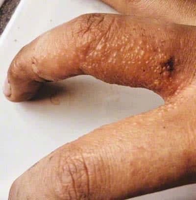 Poison ivy rash on fingers.