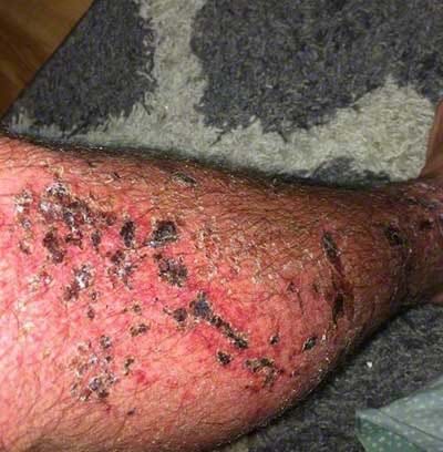 Severe Poison ivy rash on the leg.