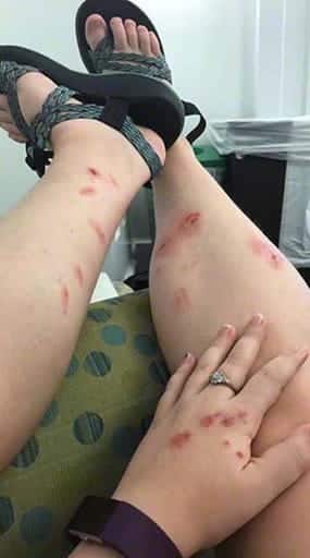 Poison Ivy Rash on a woman's hand and legs.
