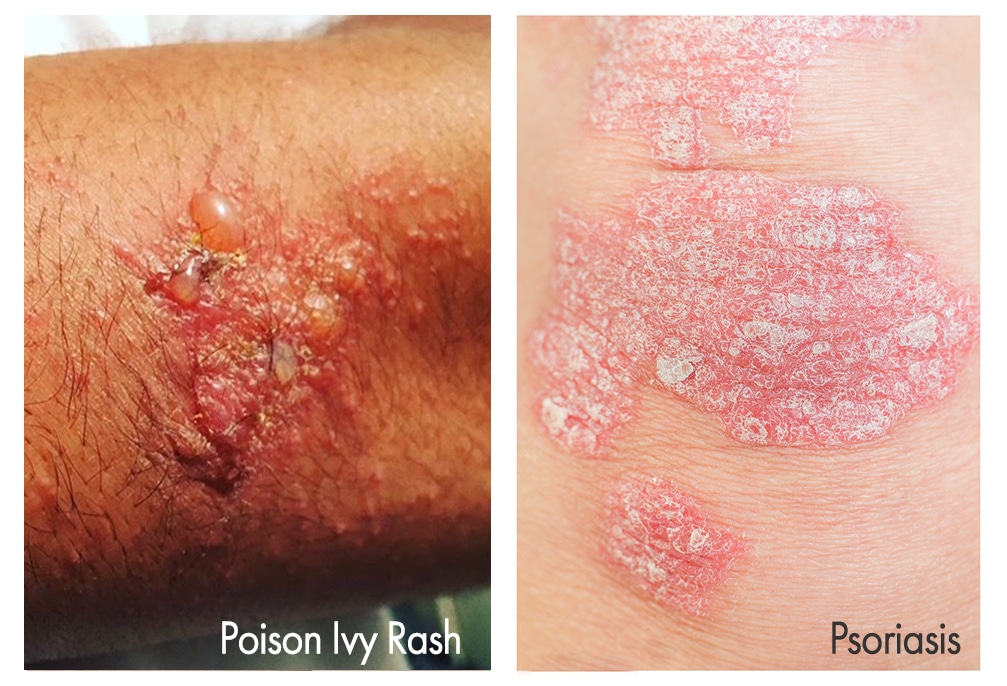 Poison ivy rash versus Psoriasis: What's the difference?